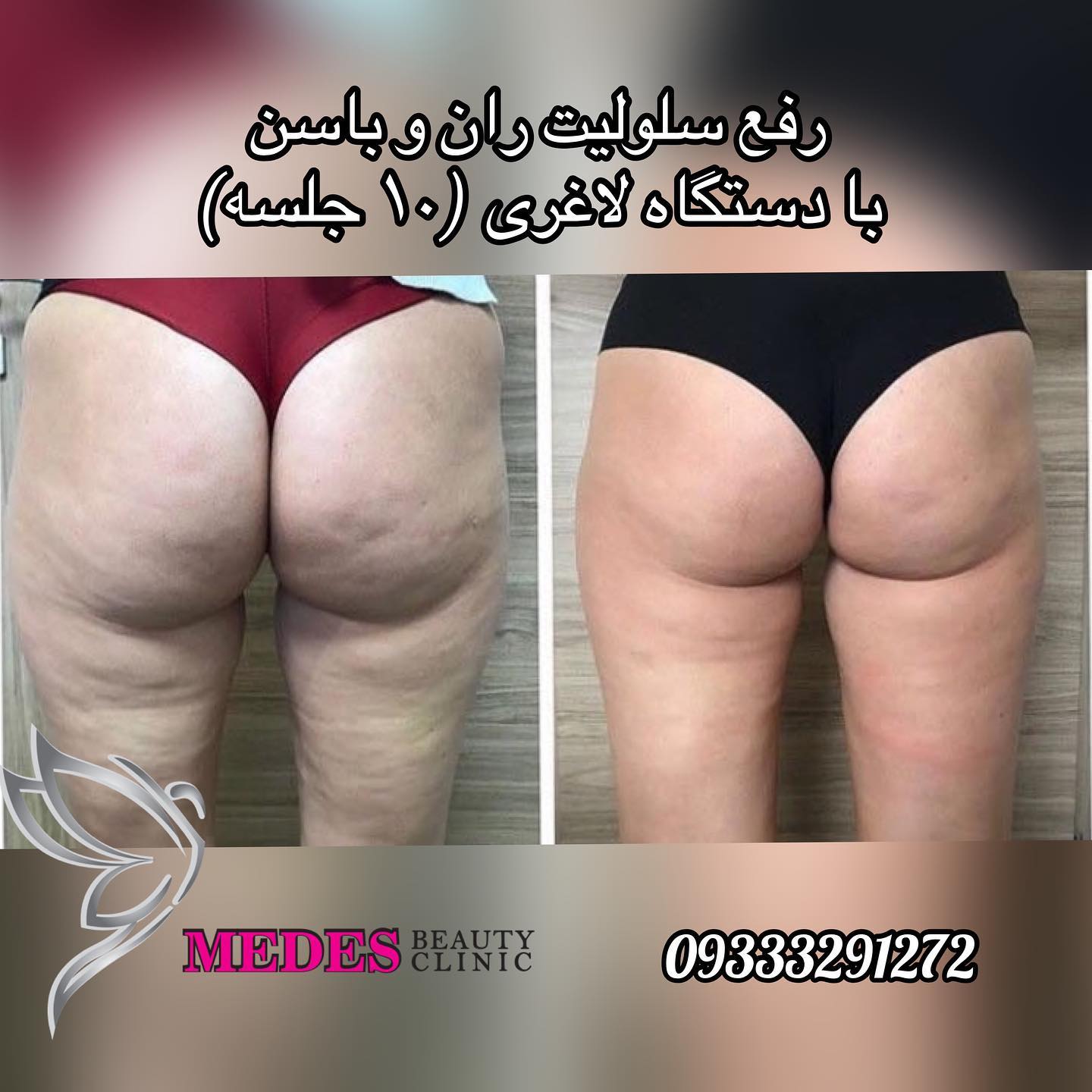 گالری لاغری با دستگاه